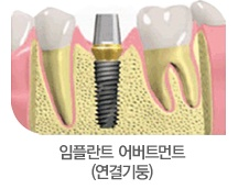 앞니임플란트 가격,앞니임플란트수술후두통있나요 관련 이미지 4