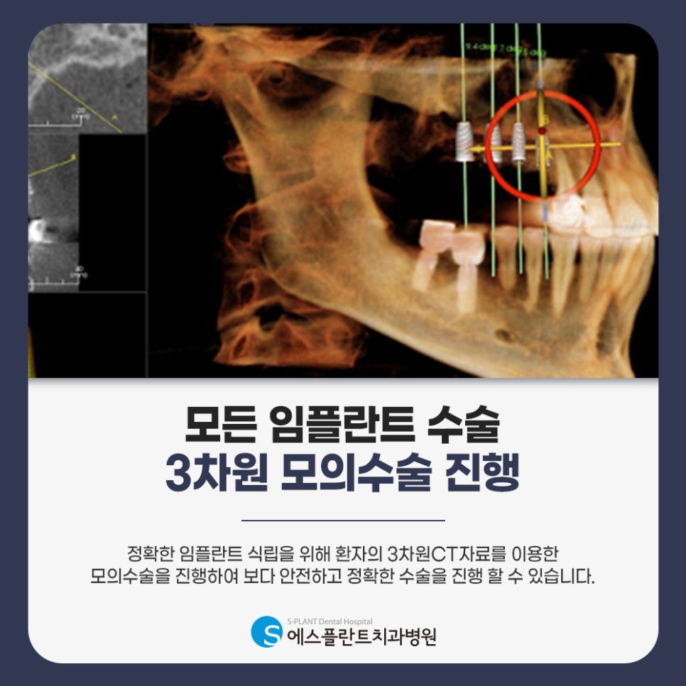 Tips for Practicing Implant Care in Daily Life image 3
