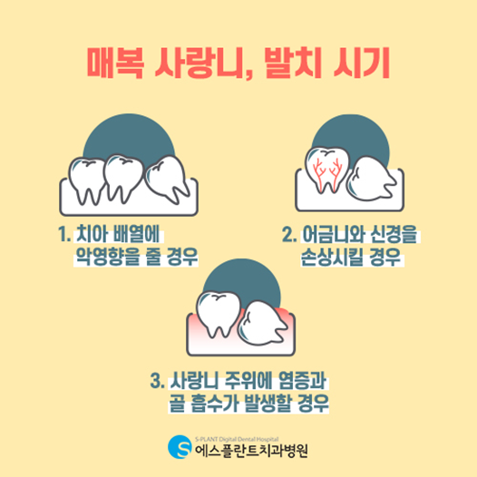 매복 사랑니 발치, 왜 필요할까요? 관련 이미지 3