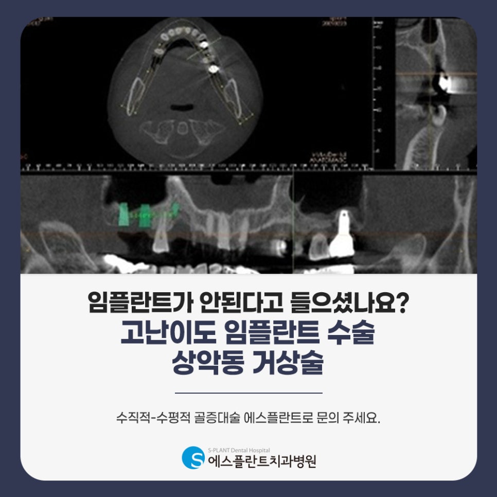 Tips for Practicing Implant Care in Daily Life image 4
