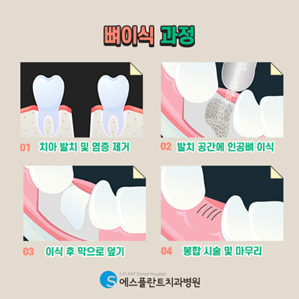 뼈이식임플란트 이렇게 진행됩니다. 관련 이미지 2