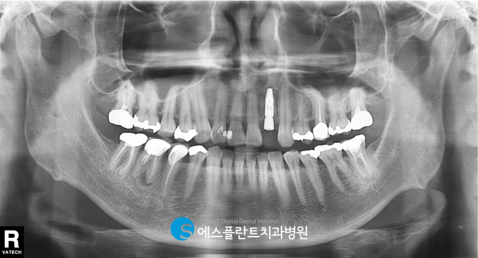 아름다운 미소를 위한 앞니 임플란트는 압구정로데오 에스플란트 치과병원에서 관련 이미지 7