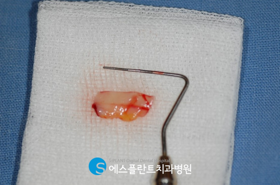 에스플란트치과병원의 잇몸이식술(Connective Tissue Graft, CTG) 로 단단한 잇몸 만들기 관련 이미지 4