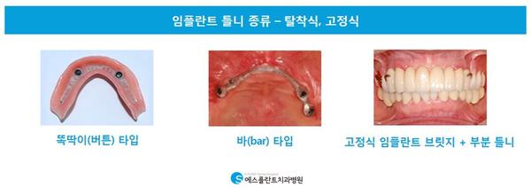 단단한고정으로걱정없는임플란트틀니 관련 이미지 3