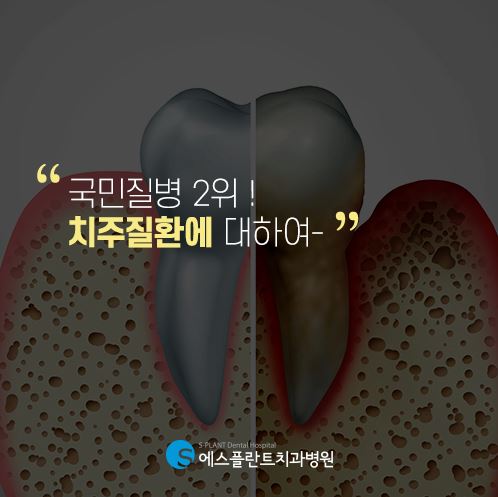국민질병 2위, 치주질환에 대하여 [에스플란트 치과병원] 관련 이미지 1