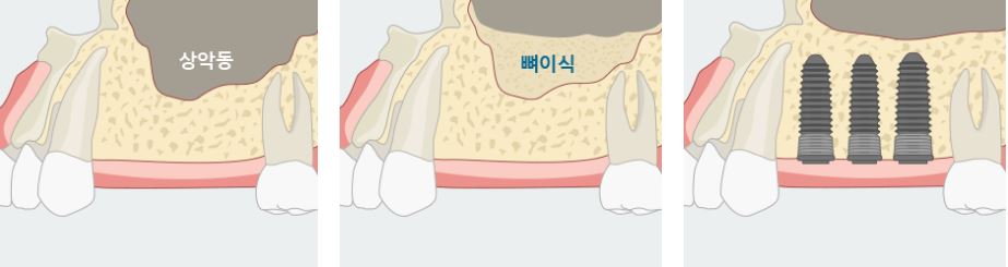 위 어금니, 잔존뼈가 부족하다면 에스플란트 치과병원의 상악동 거상술 관련 이미지 7