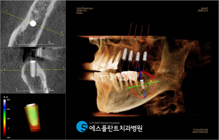 Hakdong Sageori Implant Dental Clinic: A Guide to Front Tooth Implants for a Beautiful Smile image 3