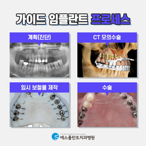 신경 손상 걱정 마세요, 에스플란트의 가이드 임플란트 관련 이미지 4