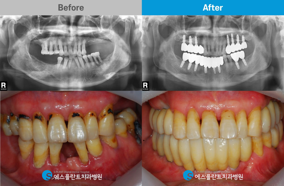 임플란트 잘하는 치과, 에스플란트 치과병원의 임플란트 모의수술과 가이드 제작으로 안전하게 관련 이미지 10