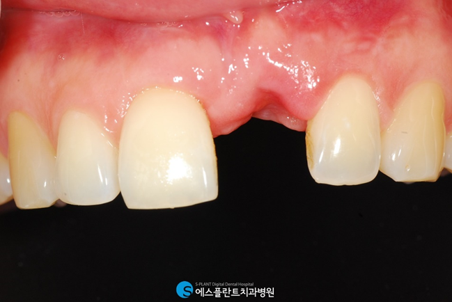 앞니를 상실했다면? 앞니임플란트가 있습니다! 관련 이미지 2