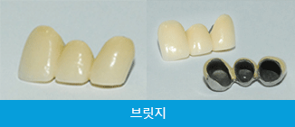 치아가 부러졌어요, 임플란트만이 답인가요? [에스플란트 치과병원] 관련 이미지 3