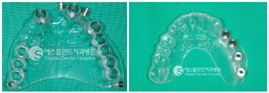 전체임플란트, 당일 임플란트 시술과정 관련 이미지 5