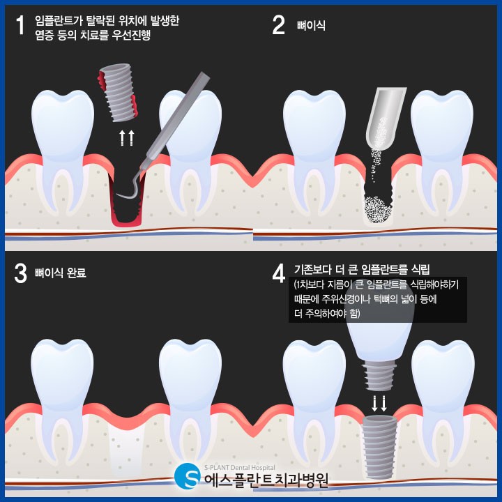 임플란트 재수술! 1차 수술과 다른점은?! 관련 이미지 4