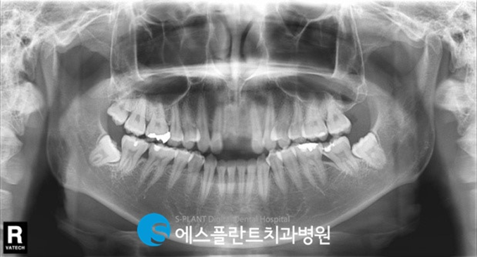 부러지고, 깨진 앞니!  앞니임플란트로 원래의 모습을 되찾을 수 있습니다. 관련 이미지 2