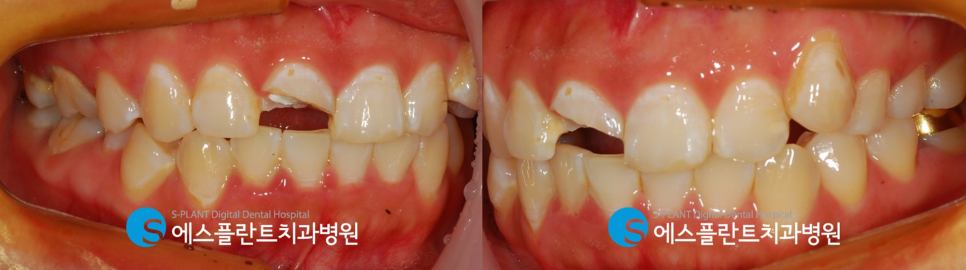 강남 부러진 앞니 임플란트 잘하는 치과, 에스플란트치과병원(전치부 발치 즉시 임플란트 및 당일 임시치아 세팅) 관련 이미지 2