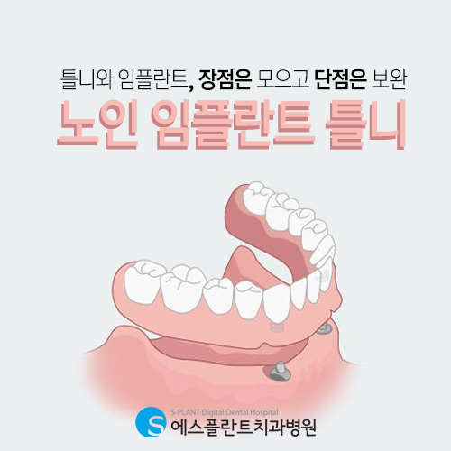 틀니와 임플란트의 장점은 모으고 단점은 보완한 노인 임플란트 틀니 [에스플란트 치과병원] 관련 이미지 3