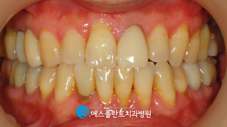 압구정로데오역 발치 후 즉시 임플란트 식립 잘하는 치과, 에스플란트 치과병원 관련 이미지 7