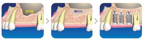 에스플란트치과병원 뼈이식임플란트 전문의와 상의하세요 관련 이미지 13