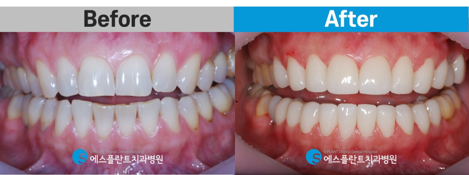 앞니 콤플렉스가 있다면?! 강남 심미보철 잘하는 치과, 에스플란트치과병원의 심미보철로 개선 관련 이미지 7