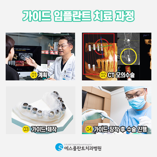 정확한 길을 찾아 안전하게 식립하는 가이드 임플란트 [에스플란트 치과병원] 관련 이미지 4