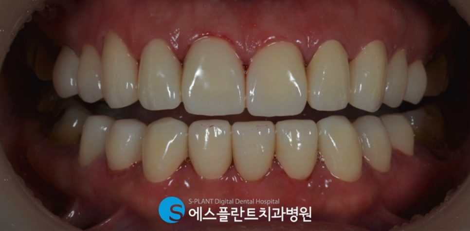 압구정 심미보철 치과, 에스플란트치과병원에서 치아를 예쁘고 가지런하게 관련 이미지 6