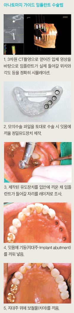 잇몸 레이저로 적게 째 손상 최소화 &hellip; 시술 시간도 1/3로 줄여 관련 이미지 2