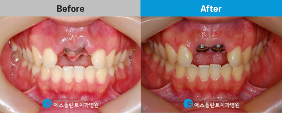1:1 전담 상담 및 진료를 통한 에스플란트치과의 고난이도 관련 이미지 8