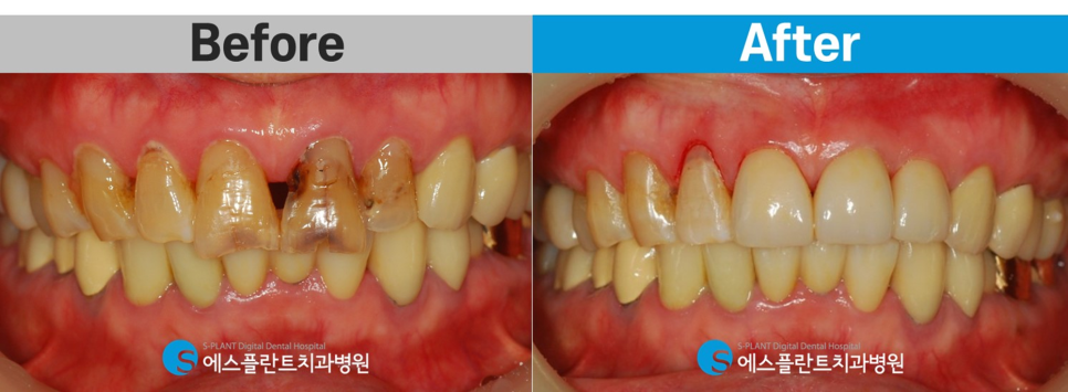 치아노화로 인한 기능 및 심미적인 부분의 개선을 원한다면?! 강남 앞니 심미보철 잘하는 치과 에스플란트치과병원에서 관련 이미지 6