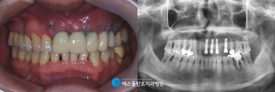 강남 디지털 가이드 임플란트를 통해 오차를 줄이며 안정적으로 식립 관련 이미지 6