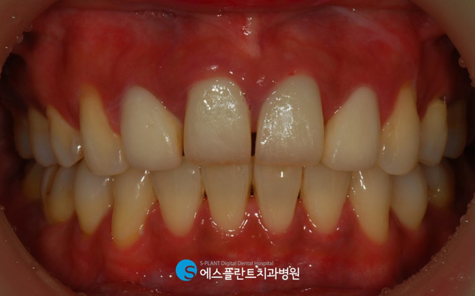 압구정로데오 앞니 벌어짐 정중이개 치료 잘하는 치과, 에스플란트치과병원의 전치부 심미보철 관련 이미지 2