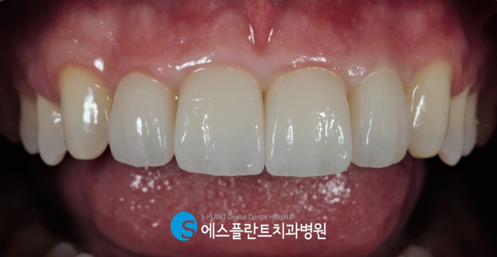 청담 에스플란트치과병원의 전치부 앞니 지르코니아 크라운 심미보철로 치아를 예쁘고 가지런하게 관련 이미지 7