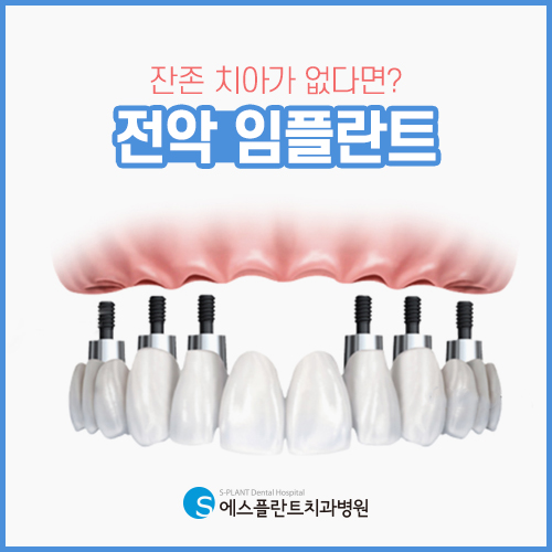 강남 임플란트 잘하는 치과병원의 전악 임플란트 [에스플란트 치과병원] 관련 이미지 4