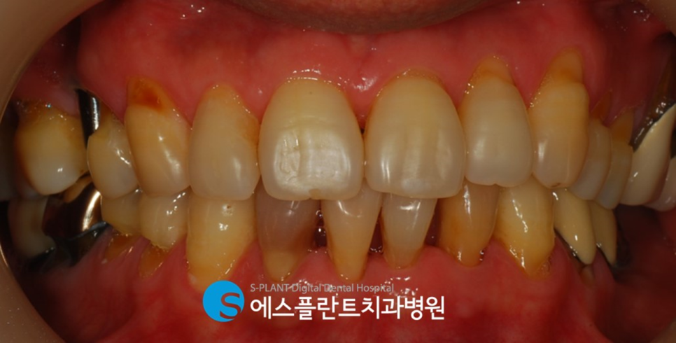 심미보철 치료 잘하는 치과 에스플란트치과병원의 지르코니아 보철 관련 이미지 1