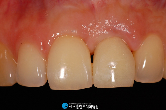 앞니를 상실했다면? 앞니임플란트가 있습니다! 관련 이미지 5