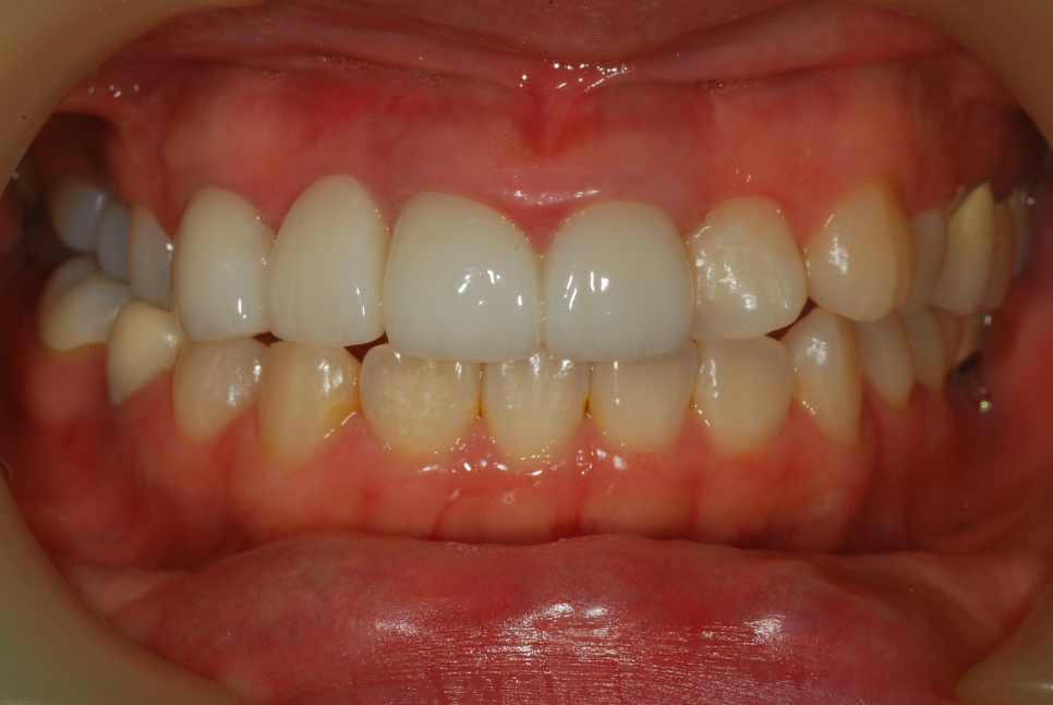 강남 잇몸치료, 치은절제술(gingivectomy)이 가능한 치과를 찾고 있다면?! 관련 이미지 4