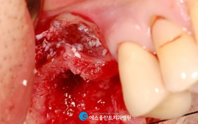 고난이도 임플란트 상악동거상술이 필요한 경우는? 관련 이미지 3