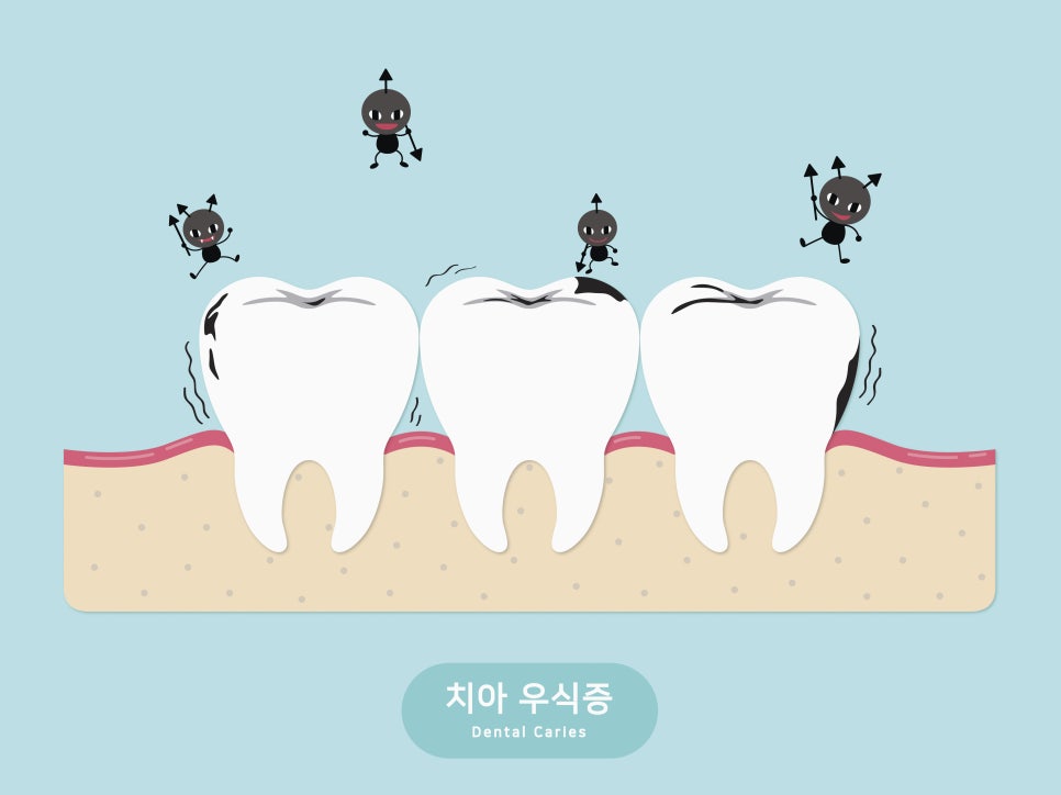 손상된 치아를 발치하지 않고 최대한 보존하는 에스플란트의 충치 치료 관련 이미지 2