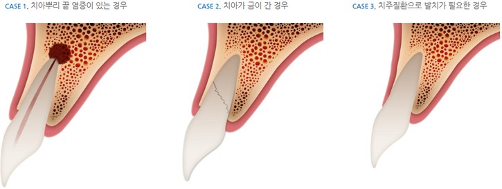[압구정로데오역 치과] 앞니 임플란트, 케이스별 맞춤 치료가 중요한 임 플란트! 관련 이미지 3