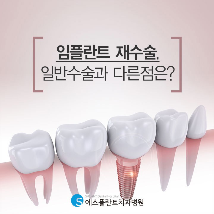 임플란트 재수술, 일반수술과 다른점은? 관련 이미지 1