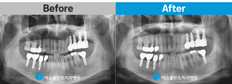 에스플란트치과병원의 고난이도 상악동 거상술을 동반한 임플란트 식립 후 10년 경과 케이스 관련 이미지 9