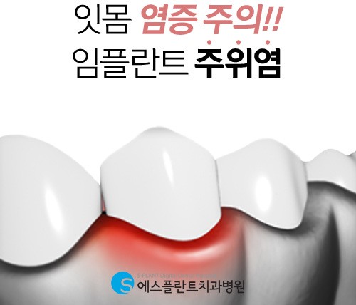 심각하면 재수술까지 이어지는 임플란트 주위염 예방방법은? 관련 이미지 1