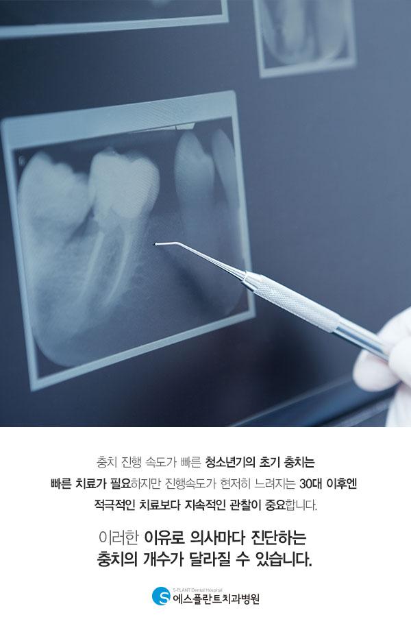 올바른 치과 문화 만들기(충치) Step1. 관련 이미지 5