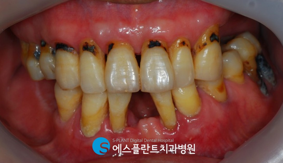 임플란트 잘하는 치과, 에스플란트 치과병원의 임플란트 모의수술과 가이드 제작으로 안전하게 관련 이미지 2