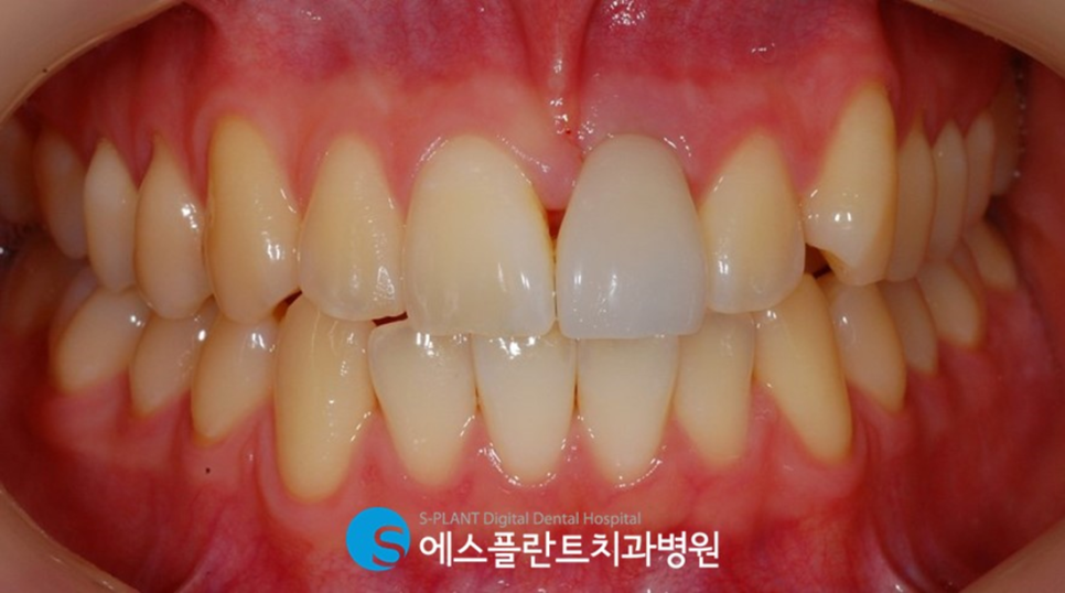 치아외상으로 인한 전치부 심미보철 임플란트는 강남 에스플란트 치과병원에서 관련 이미지 1