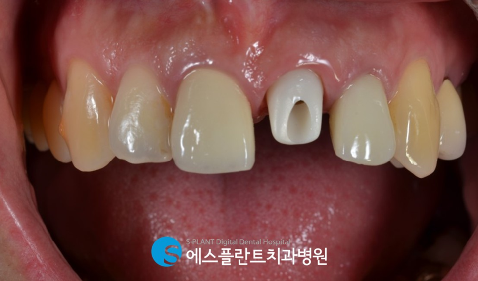 압구정로데오역 임플란트치과 에스플란트치과병원의 심미성을 고려한 지르코니아 지대주 앞니 임플란트 관련 이미지 4