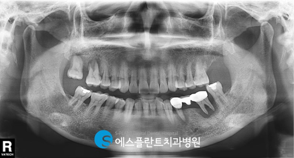 강남 압구정로데오 임플란트 잘하는 치과, 에스플란트치과병원의 브릿지 제거 후 임플란트 식립 관련 이미지 2