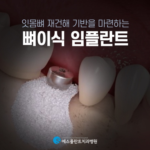 뼈이식 임플란트, 튼튼한 뼈는 임플란트 성공의 핵심 [에스플란트 치과병원] 관련 이미지 3