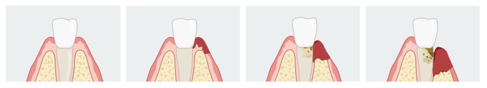 임플란트 주위염 예방법 없나요? 원인부터 해결방안까지 관련 이미지 2