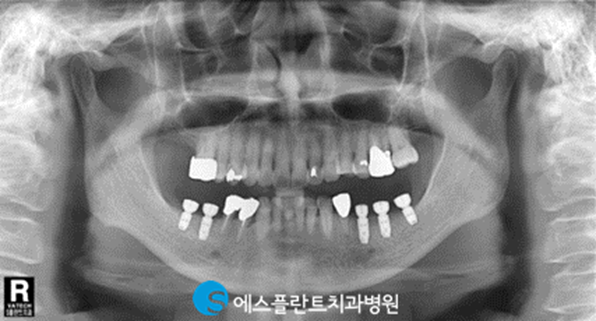 편안한 식사를 위한 어금니임플란트, 에스플란트치과에서 안전하게 진행하세요. 관련 이미지 4