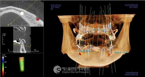 [당뇨 임플란트] 당뇨 환자도 가능한 덴탈 CT를 이 용한 아나토마지가이드 임플란트! 관련 이미지 5